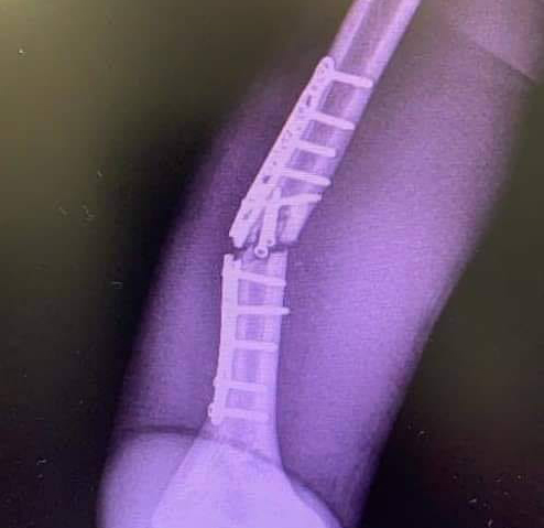 Marc Marquez的骨折固定鈦板斷裂,緊急進行第二次的手術